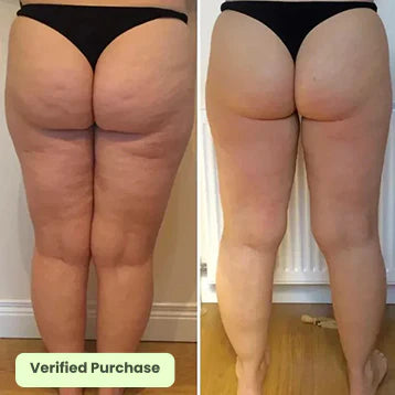 Glowyn Cellulite Smoothing System