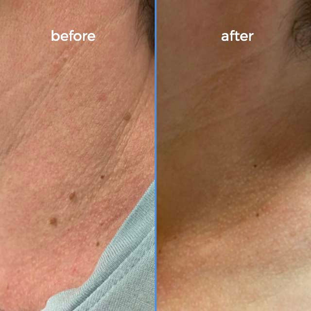 Goodbye Tags Kit - No More Skin Tags