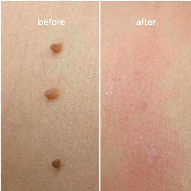 Goodbye Tags Kit - No More Skin Tags