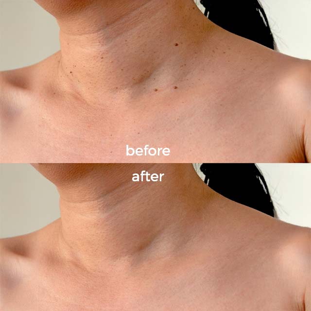 Goodbye Tags Kit - No More Skin Tags