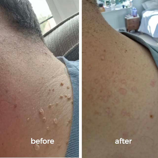 Goodbye Tags Kit - No More Skin Tags
