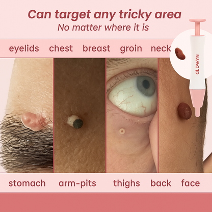 Goodbye Tags Kit - No More Skin Tags