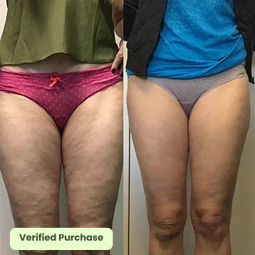 Glowyn Cellulite Smoothing System